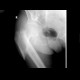 Spiral subtrochanteric fracture: X-ray - Plain radiograph